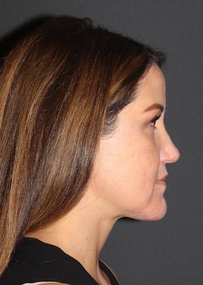 Facetite Before & After Gallery - Patient 166555 - Image 2