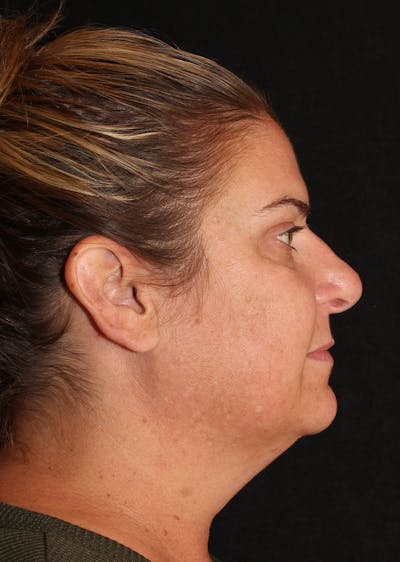 Facetite Before & After Gallery - Patient 400058 - Image 1
