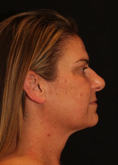 Facetite Before & After Gallery - Patient 400058 - Image 2