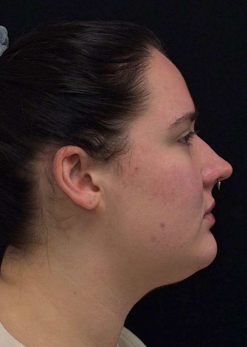 Facetite/Quantum RF Before & After Gallery - Patient 158326 - Image 1