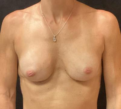 Preservé Breast Augmentation Before & After Gallery - Patient 198055 - Image 2
