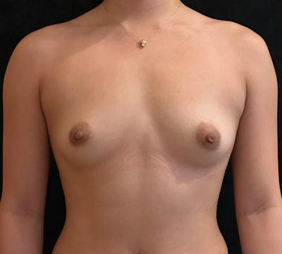Preservé Breast Augmentation Before & After Gallery - Patient 392359 - Image 1