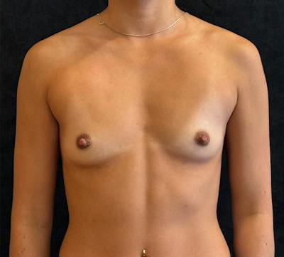 Breast Augmentation Subfascial Before & After Gallery - Patient 283478 - Image 1