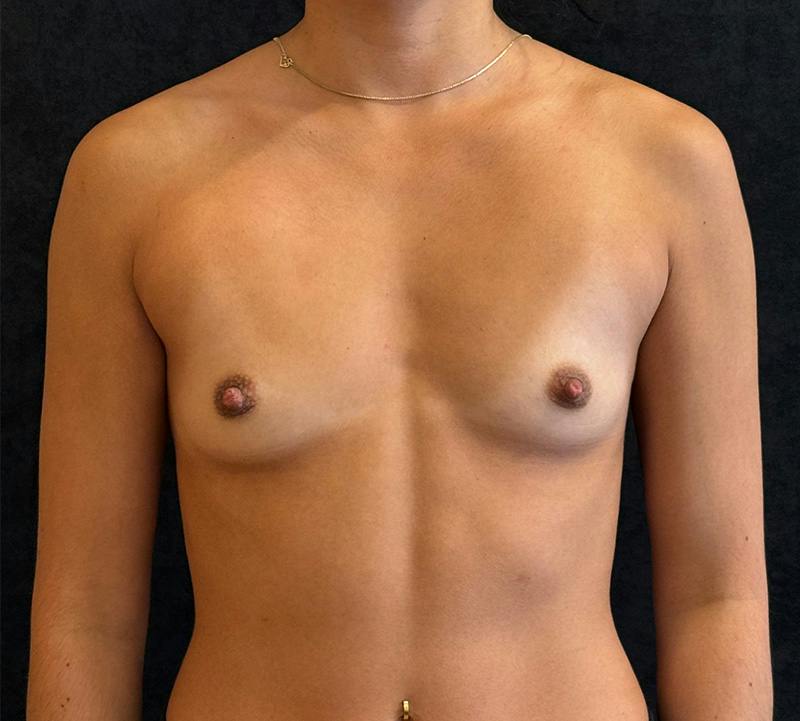 Breast Augmentation Subfascial Before & After Gallery - Patient 283478 - Image 1