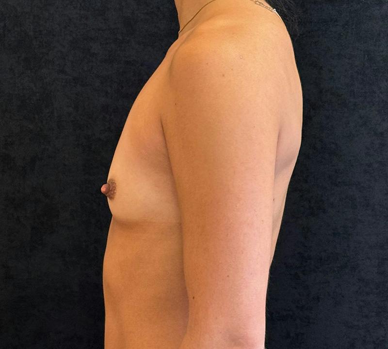 Breast Augmentation Subfascial Before & After Gallery - Patient 283478 - Image 9