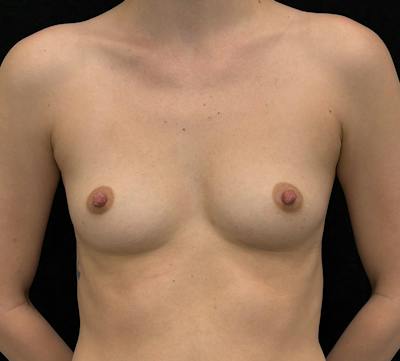 Breast Augmentation Subfascial Before & After Gallery - Patient 501233 - Image 1