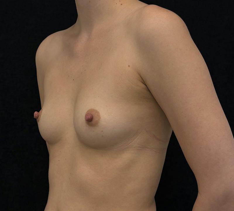 Breast Augmentation Subfascial Before & After Gallery - Patient 501233 - Image 7