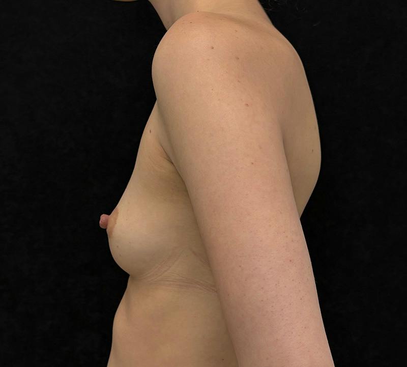 Breast Augmentation Subfascial Before & After Gallery - Patient 501233 - Image 9
