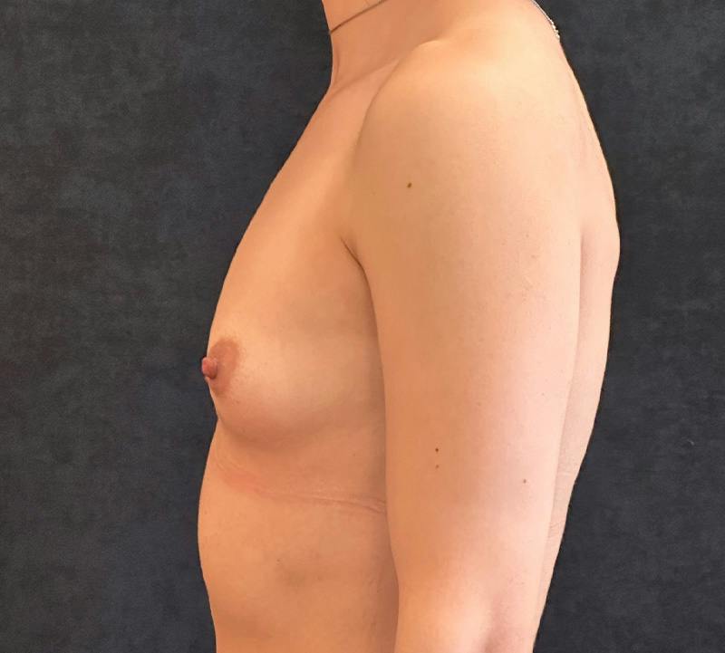Breast Augmentation Subfascial Before & After Gallery - Patient 792350 - Image 9