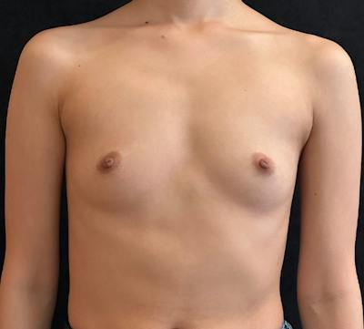 Breast Augmentation Subfascial Before & After Gallery - Patient 193251 - Image 1