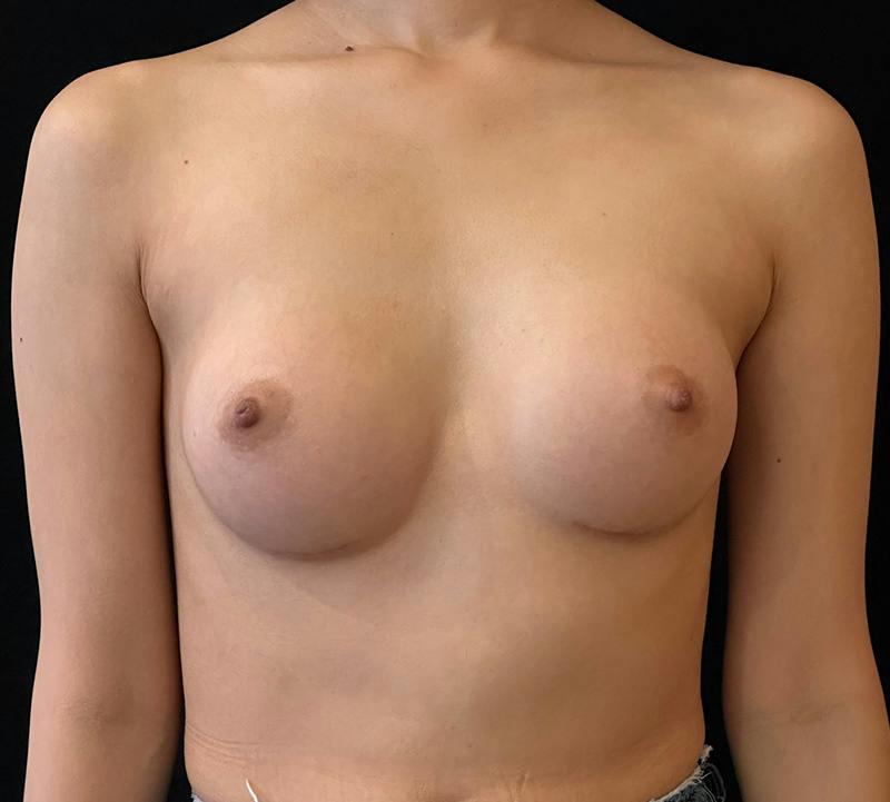 Breast Augmentation Subfascial Before & After Gallery - Patient 193251 - Image 2