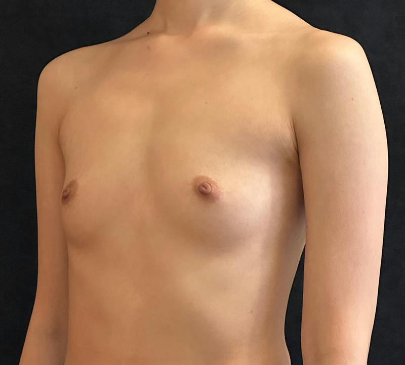 Breast Augmentation Subfascial Before & After Gallery - Patient 193251 - Image 7