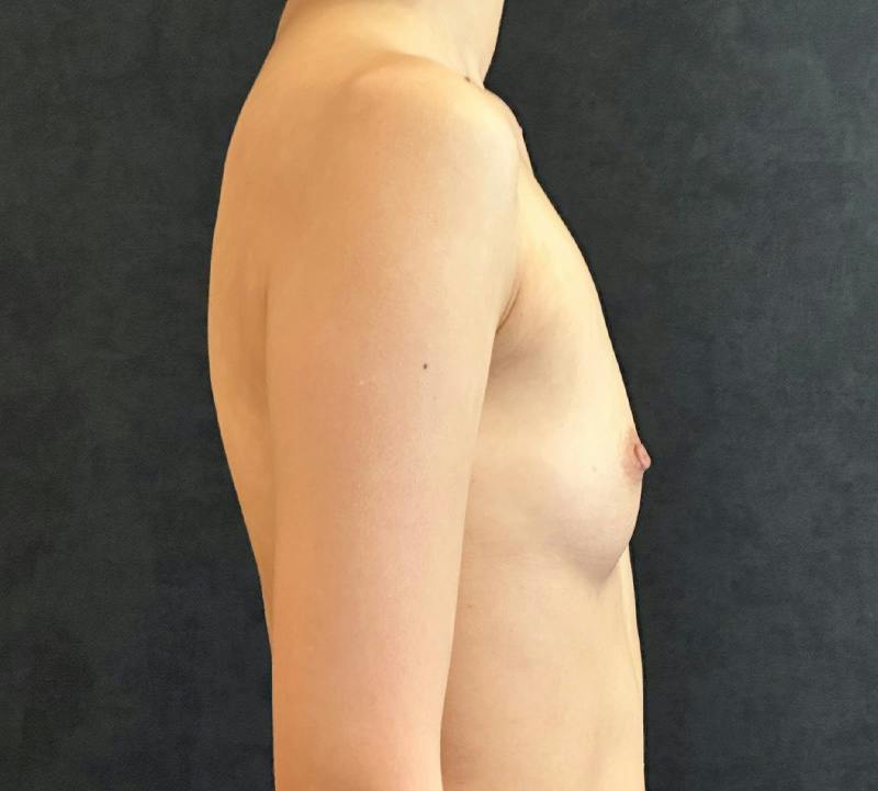 Breast Augmentation Subfascial Before & After Gallery - Patient 193251 - Image 5
