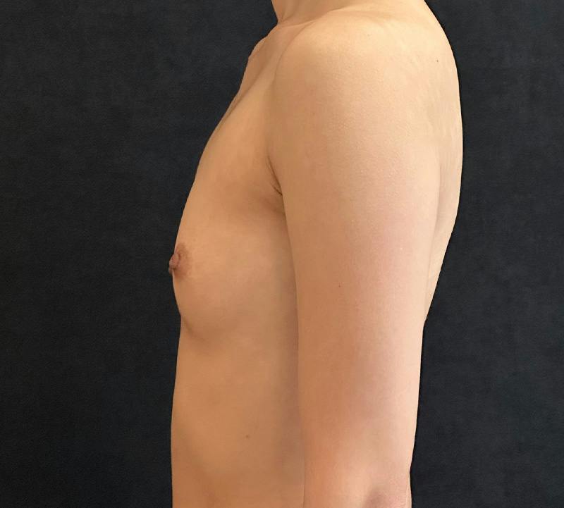 Breast Augmentation Subfascial Before & After Gallery - Patient 193251 - Image 9