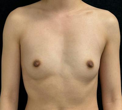 Breast Augmentation Subfascial Before & After Gallery - Patient 316617 - Image 1