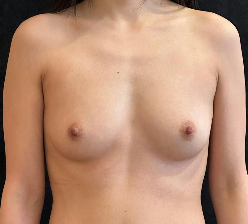 Breast Augmentation Subfascial Before & After Gallery - Patient 160529 - Image 1