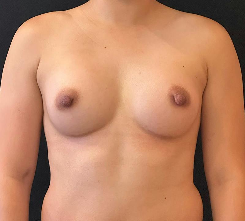 Breast Augmentation Subfascial Before & After Gallery - Patient 821989 - Image 2