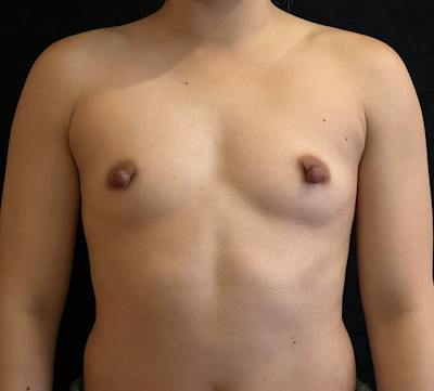 Breast Augmentation Subfascial Before & After Gallery - Patient 821989 - Image 1