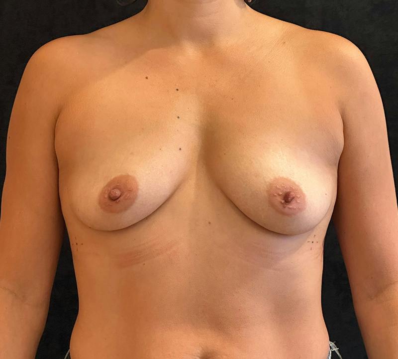Breast Augmentation Subfascial Before & After Gallery - Patient 284565 - Image 1