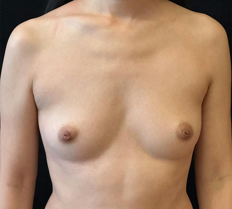 Breast Augmentation Subfascial Before & After Gallery - Patient 273563 - Image 1