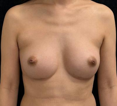 Breast Augmentation Subfascial Before & After Gallery - Patient 273563 - Image 2