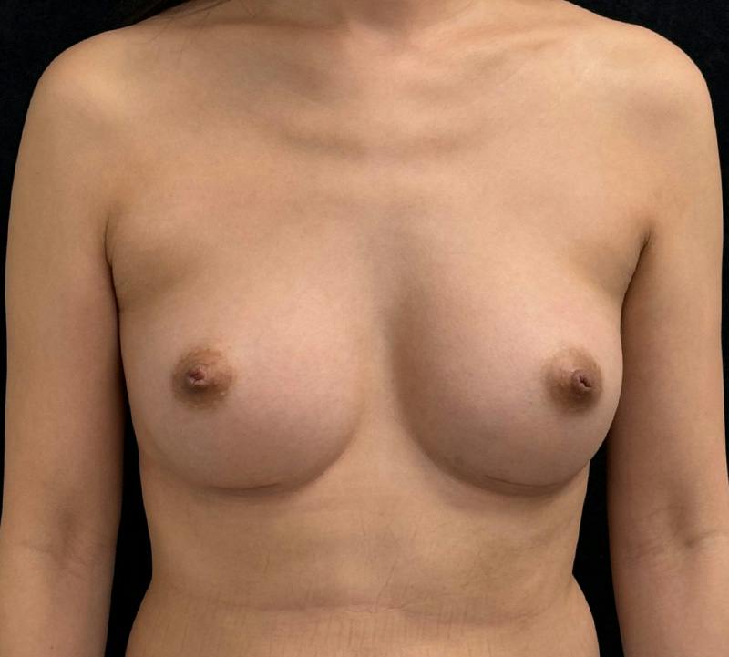 Breast Augmentation Subfascial Before & After Gallery - Patient 273563 - Image 2