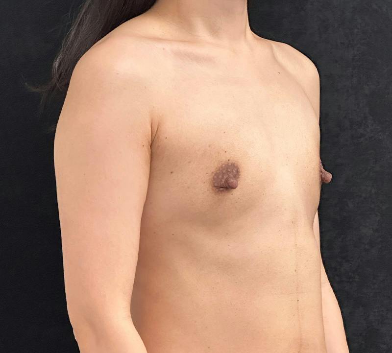 Breast Augmentation Subfascial Before & After Gallery - Patient 381569 - Image 3