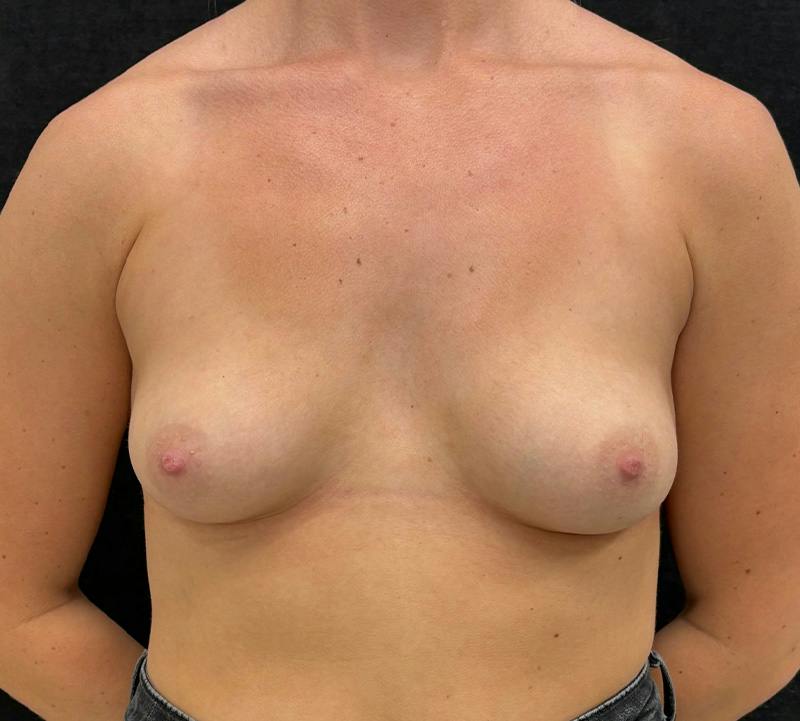 Breast Augmentation Subfascial Before & After Gallery - Patient 115728 - Image 1