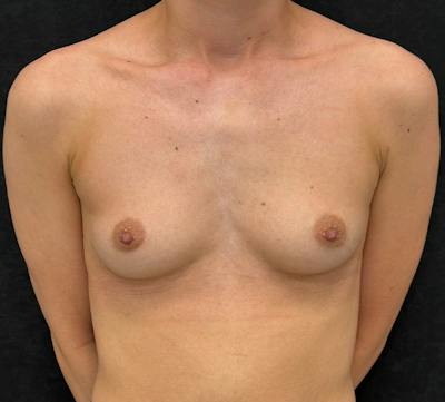 Breast Augmentation Subfascial Before & After Gallery - Patient 283694 - Image 1