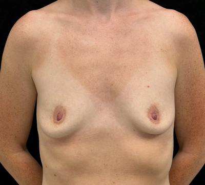 Breast Augmentation Subfascial Before & After Gallery - Patient 248846 - Image 1