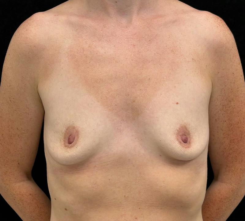 Breast Augmentation Subfascial Before & After Gallery - Patient 248846 - Image 1