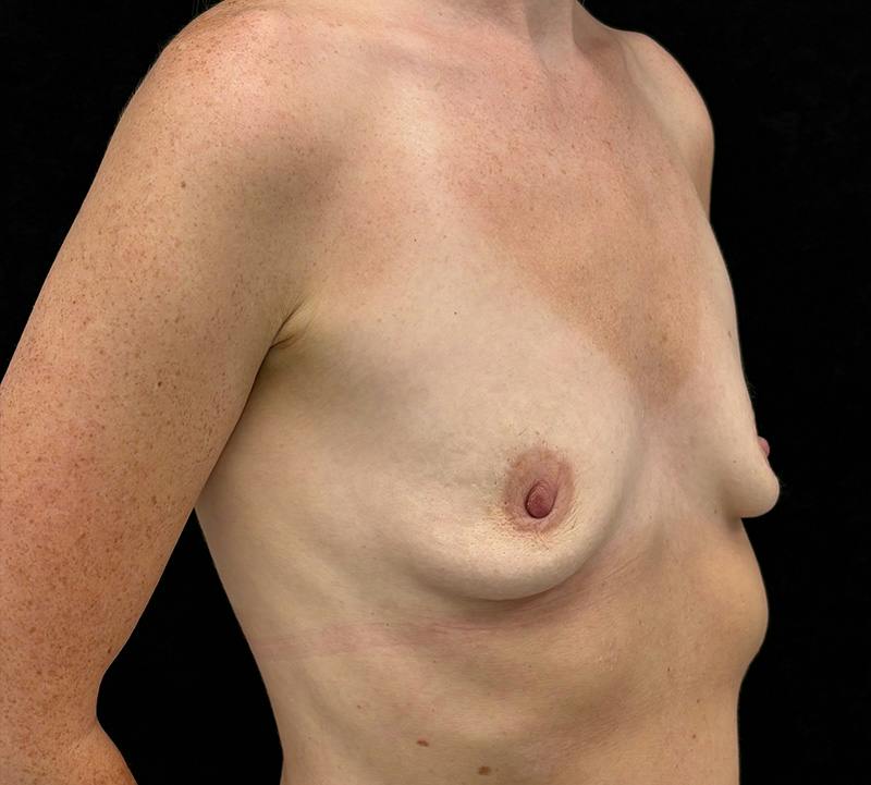 Breast Augmentation Subfascial Before & After Gallery - Patient 248846 - Image 3