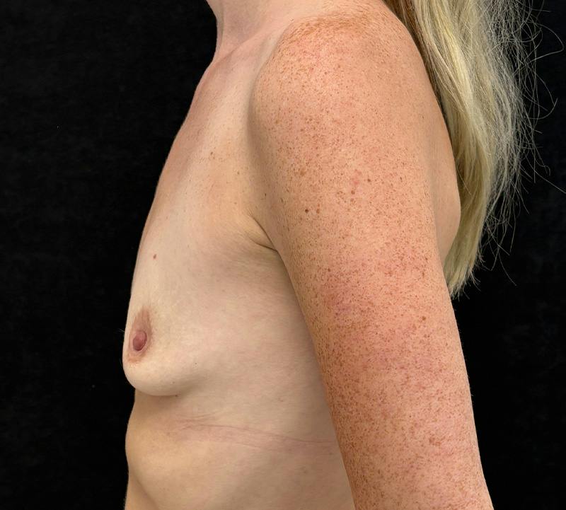Breast Augmentation Subfascial Before & After Gallery - Patient 248846 - Image 9