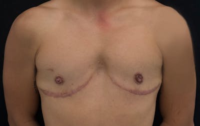 Transgender Top Surgery Before & After Gallery - Patient 127622 - Image 2