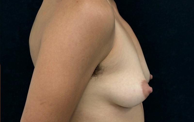 Transgender Top Surgery Before & After Gallery - Patient 127622 - Image 5