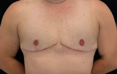 Transgender Top Surgery Before & After Gallery - Patient 170488 - Image 2