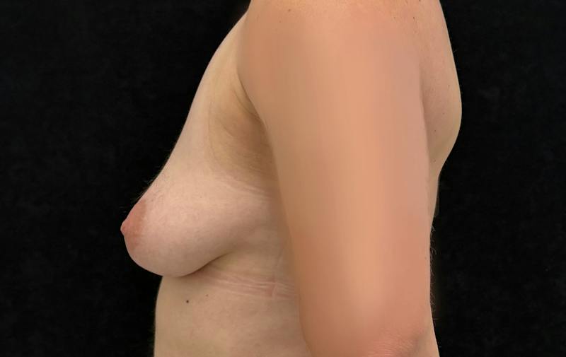 Transgender Top Surgery Before & After Gallery - Patient 170488 - Image 9