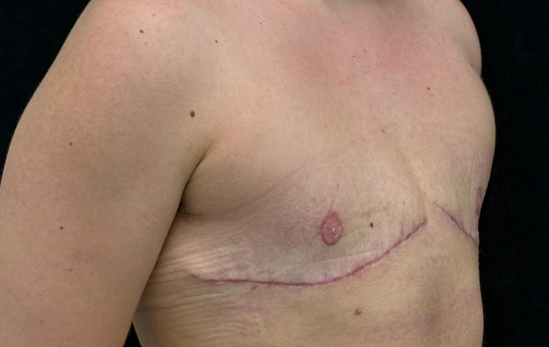 Transgender Top Surgery Before & After Gallery - Patient 945900 - Image 4
