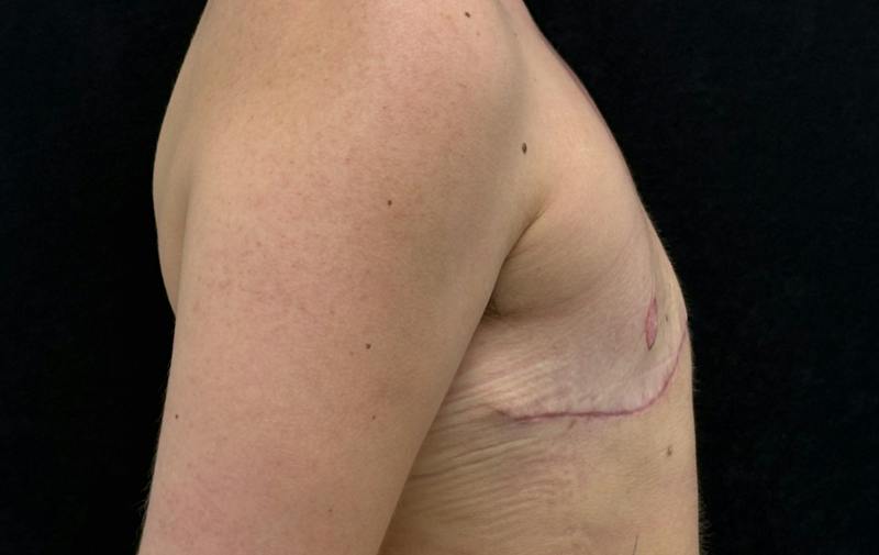 Transgender Top Surgery Before & After Gallery - Patient 945900 - Image 6