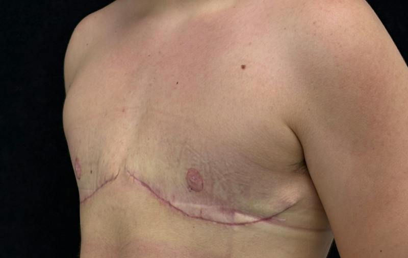 Transgender Top Surgery Before & After Gallery - Patient 945900 - Image 8