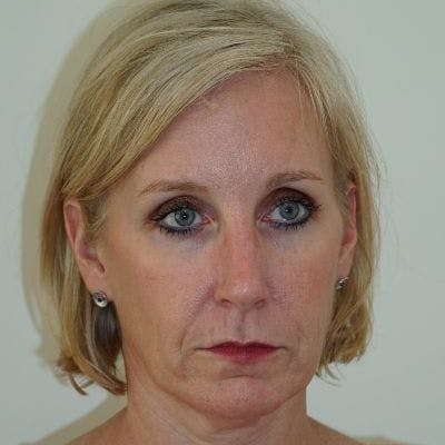Mini Facelift in Nashvile Before & After Photos