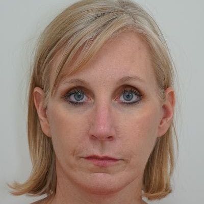 Mini Facelift in Nashvile Before & After Photos