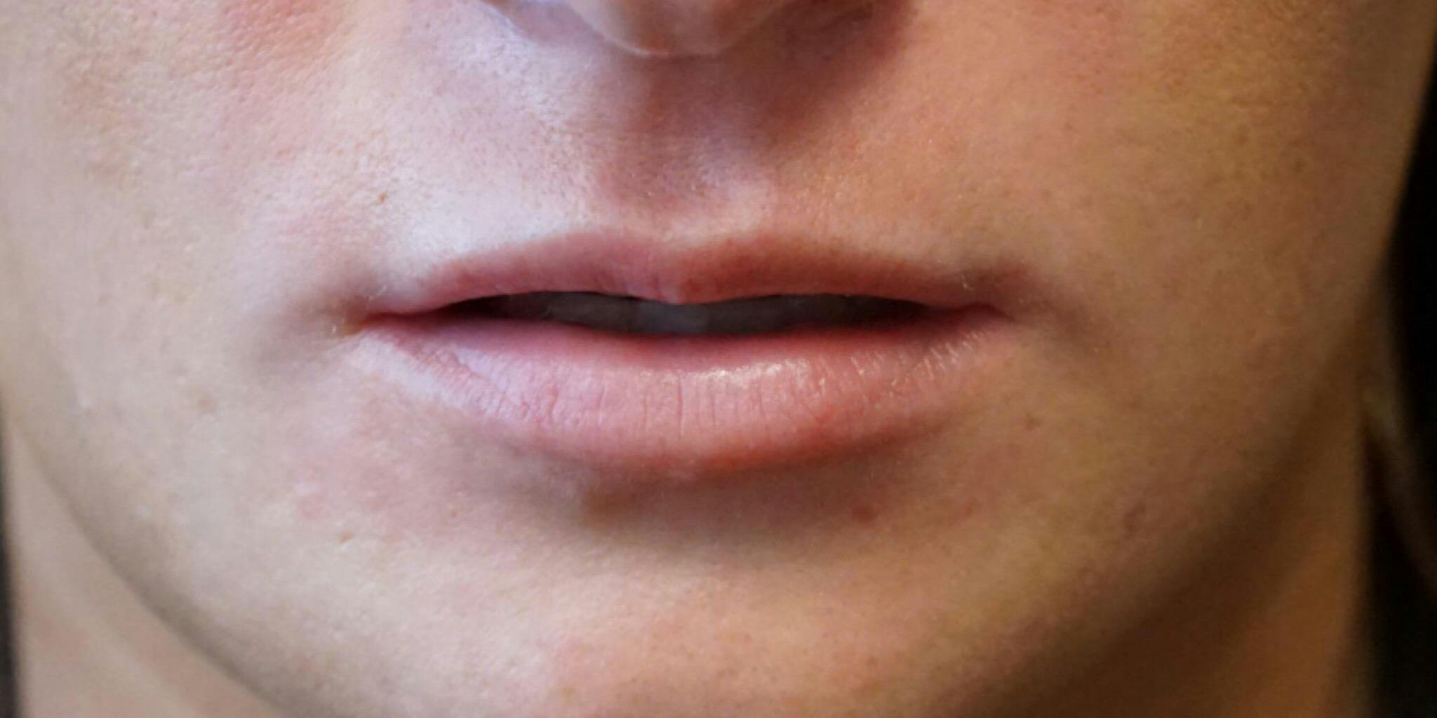 Before and after Juvederm in Nashville at Refine Facial Plastic Surgery