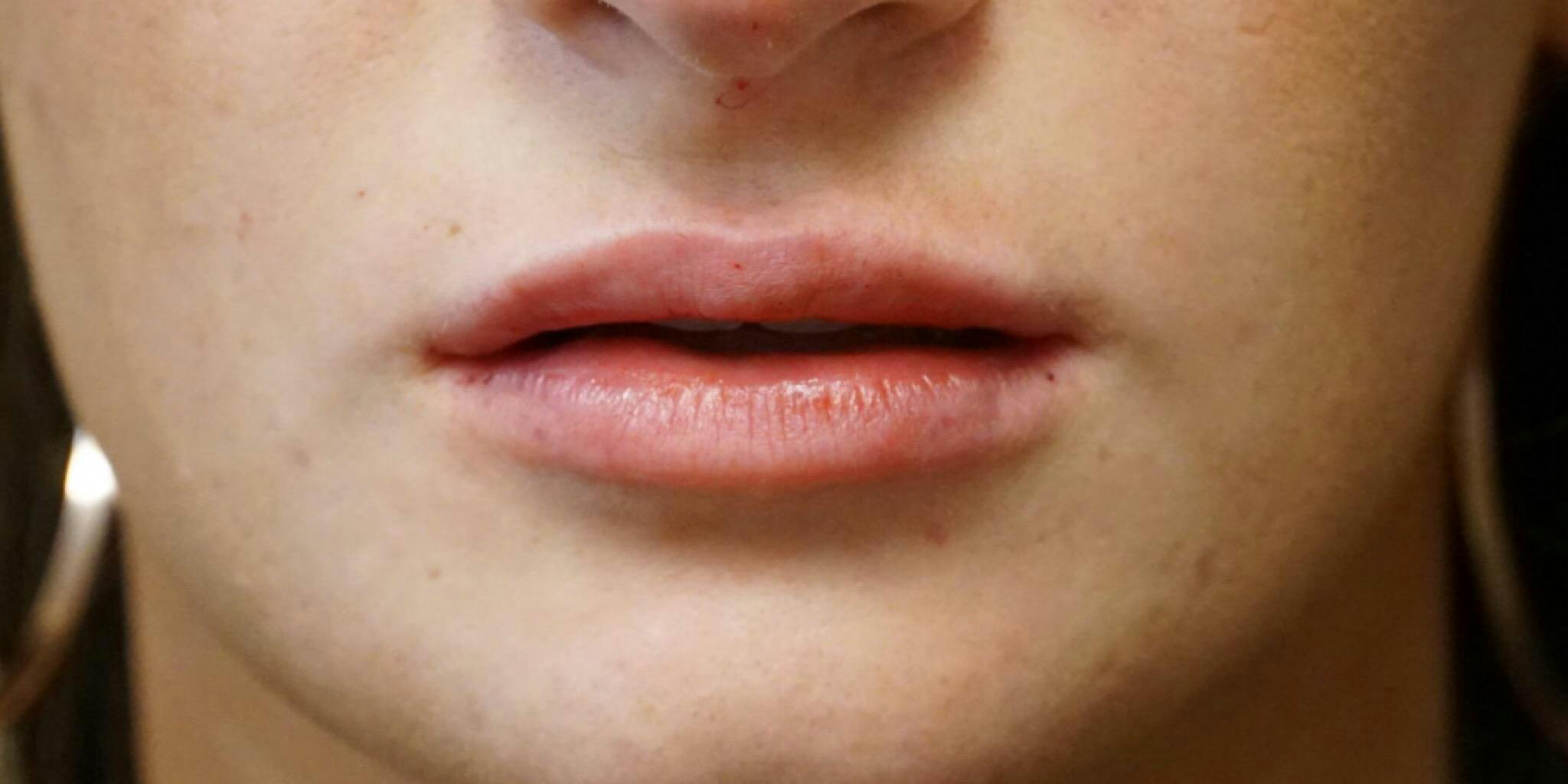 Before and after Juvederm in Nashville at Refine Facial Plastic Surgery