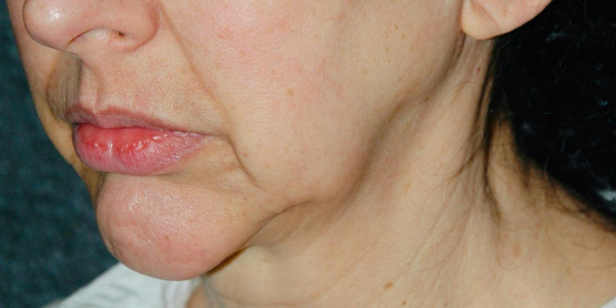 Juvederm in Nashville Before and after Photos