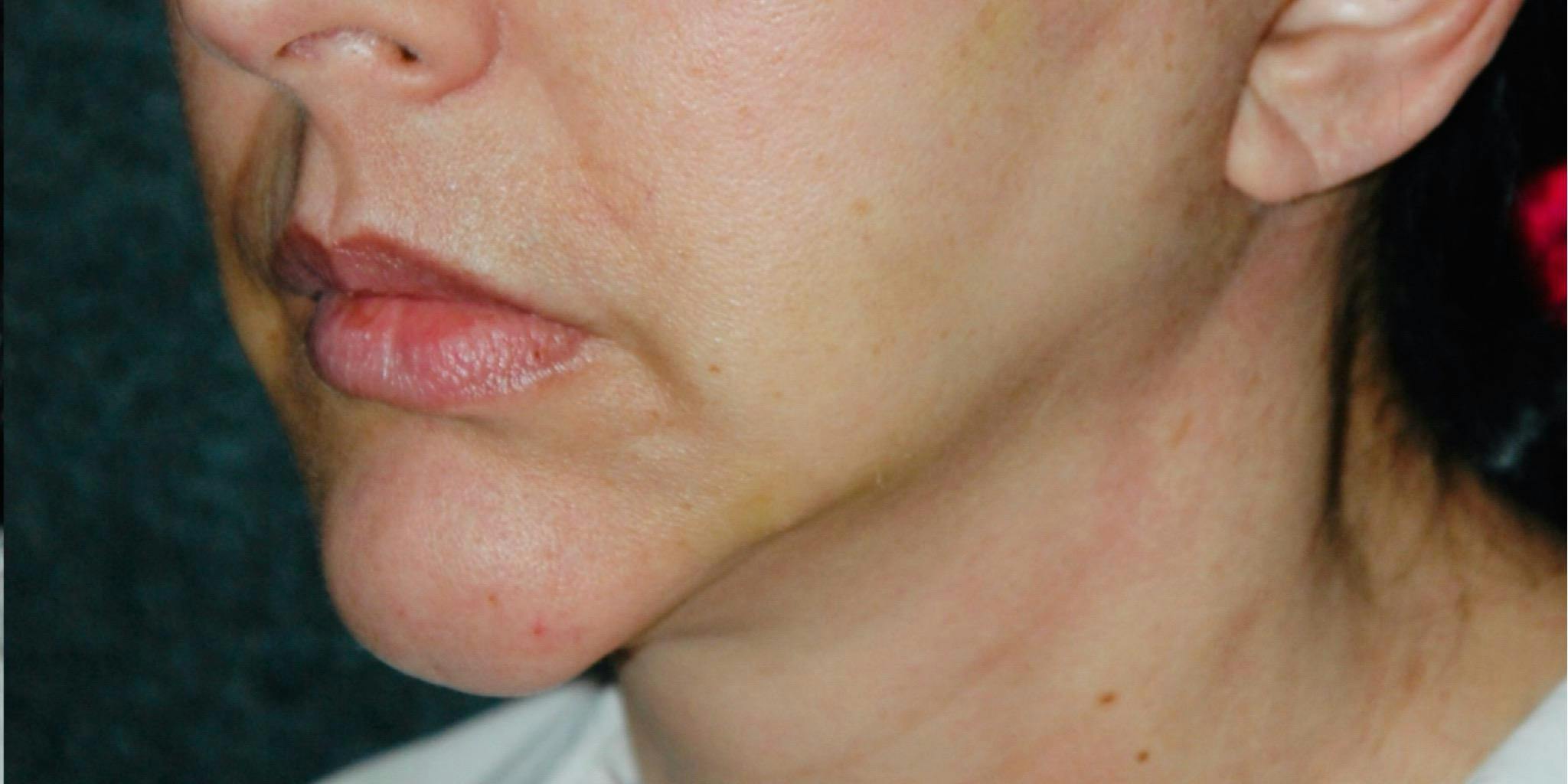 Juvederm in Nashville Before and after Photos