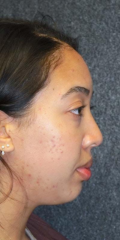 Before and after ethnic rhinoplasty in Nashville at Refine Surgery