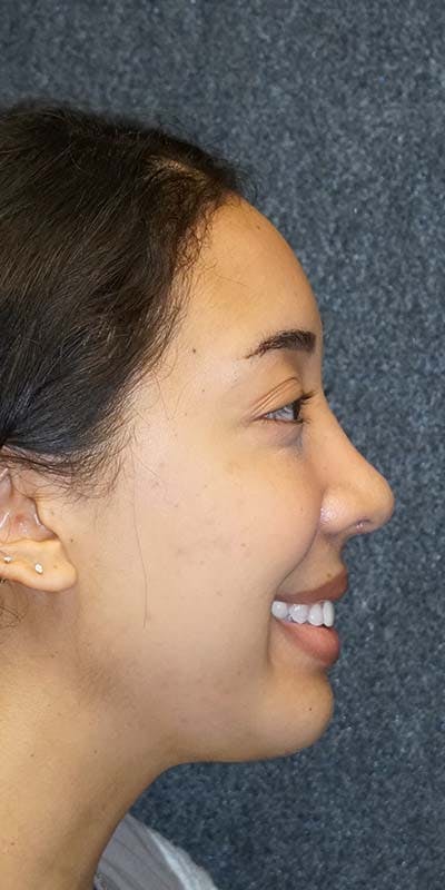 Before and after ethnic rhinoplasty in Nashville at Refine Surgery