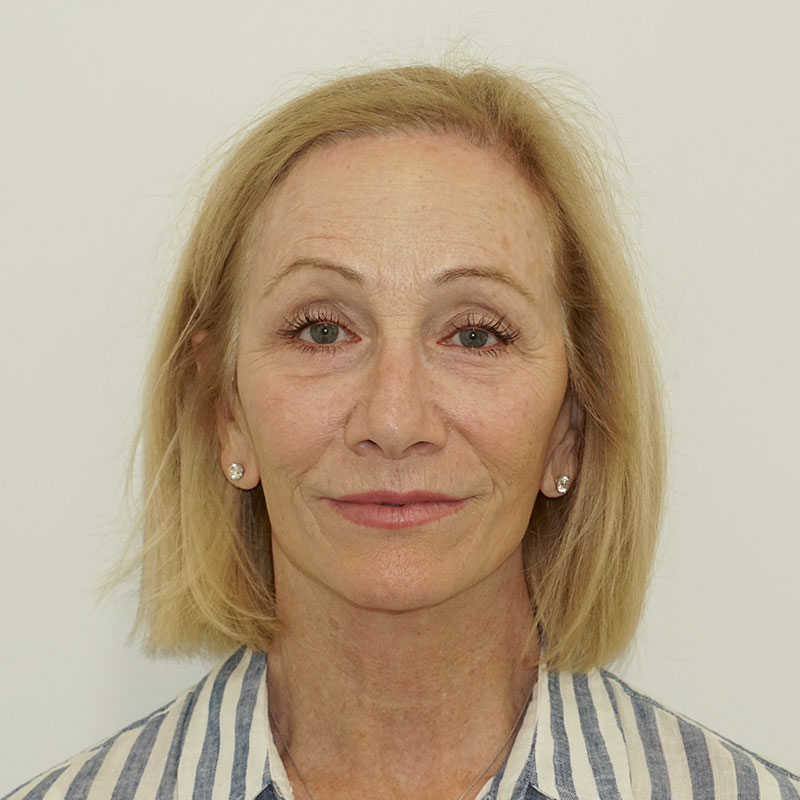 Before and after lip lift surgery in Nashville at Refine Facial Plastic Surgery and Aesthetics