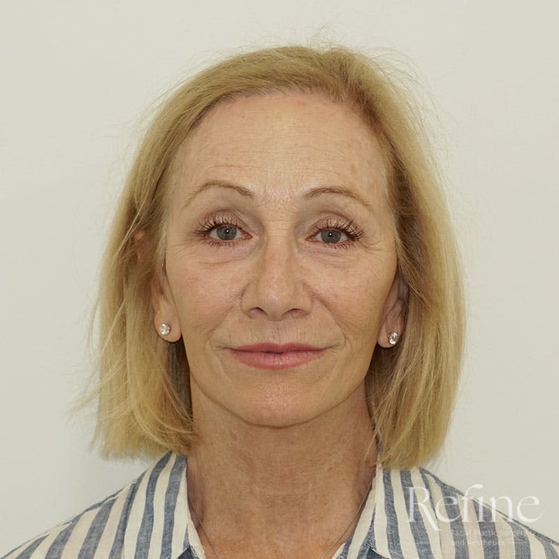 Before and after lip lift surgery in Nashville at Refine Facial Plastic Surgery and Aesthetics